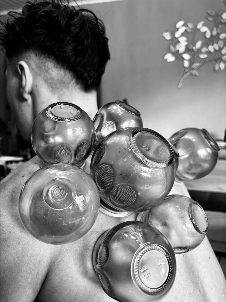 cupping therapy in montpellier